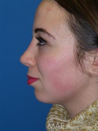 Rhinoplasty Before & After Gallery - Patient 278235 - Image 2