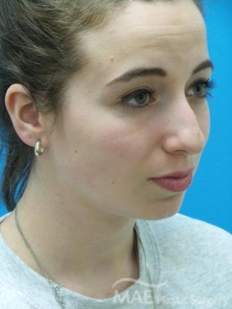 Rhinoplasty Before & After Gallery - Patient 278235 - Image 3