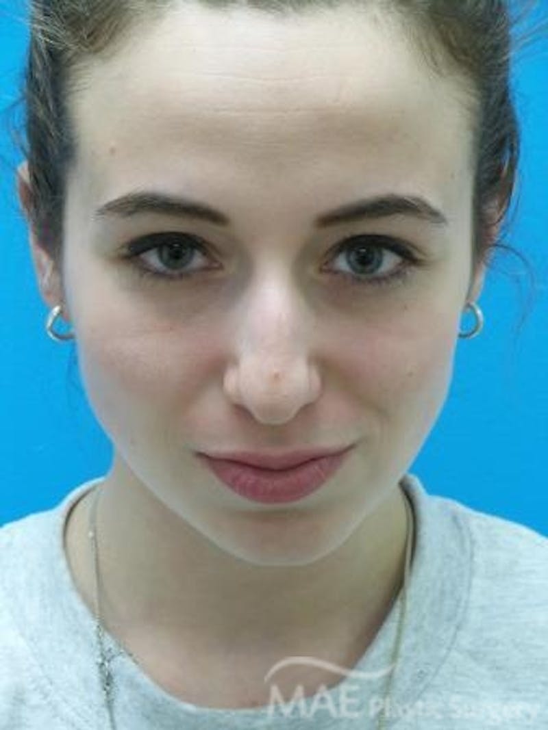 Rhinoplasty Before & After Gallery - Patient 278235 - Image 5