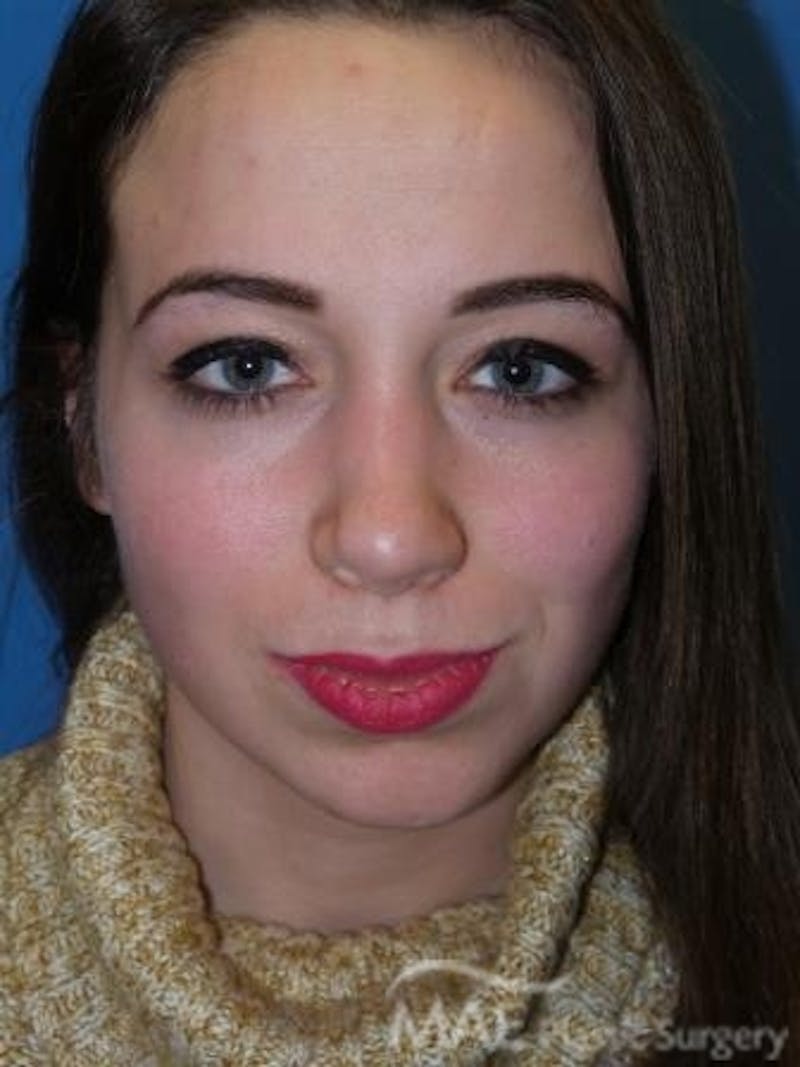 Rhinoplasty Before & After Gallery - Patient 278235 - Image 6