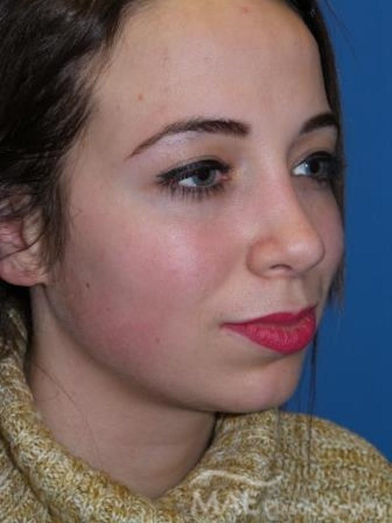 Rhinoplasty Before & After Gallery - Patient 278235 - Image 4