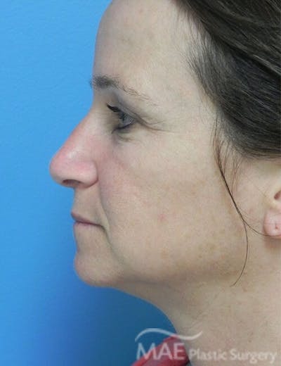 Rhinoplasty Before & After Gallery - Patient 285989 - Image 1