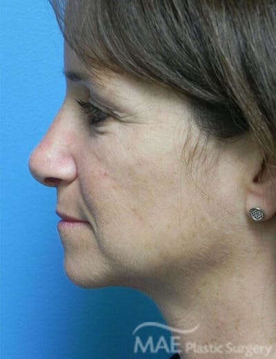 Rhinoplasty Before & After Gallery - Patient 285989 - Image 2