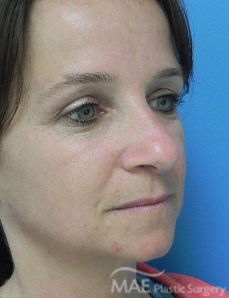 Rhinoplasty Before & After Gallery - Patient 285989 - Image 3