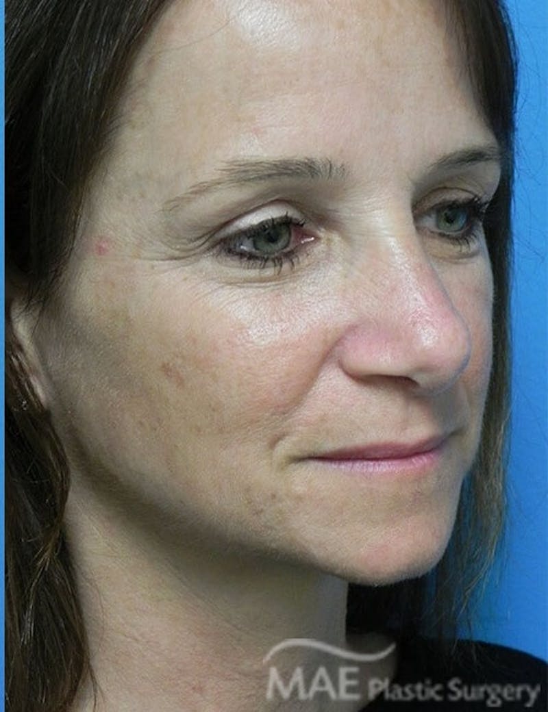 Rhinoplasty Before & After Gallery - Patient 285989 - Image 4