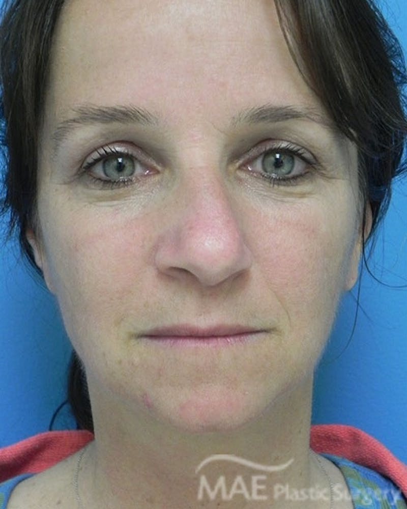 Rhinoplasty Before & After Gallery - Patient 285989 - Image 5