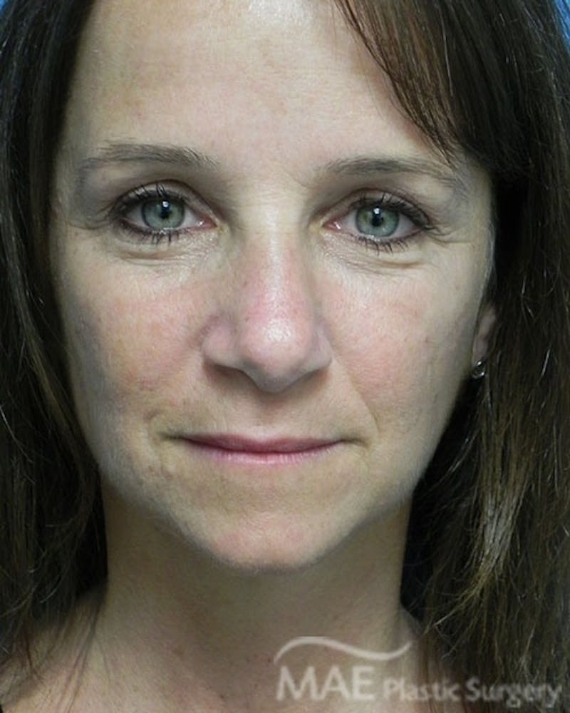 Rhinoplasty Before & After Gallery - Patient 285989 - Image 6