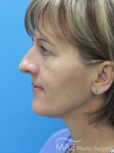 Rhinoplasty Before & After Gallery - Patient 202579 - Image 1