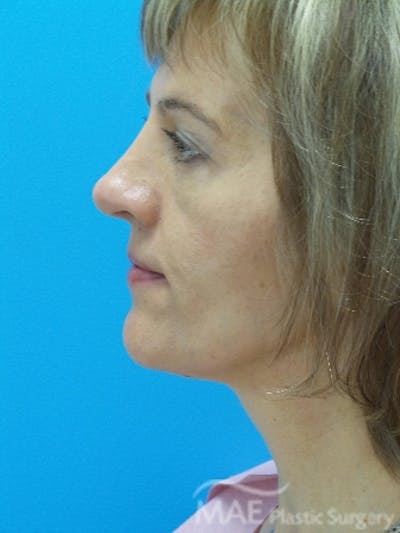 Rhinoplasty Before & After Gallery - Patient 202579 - Image 2