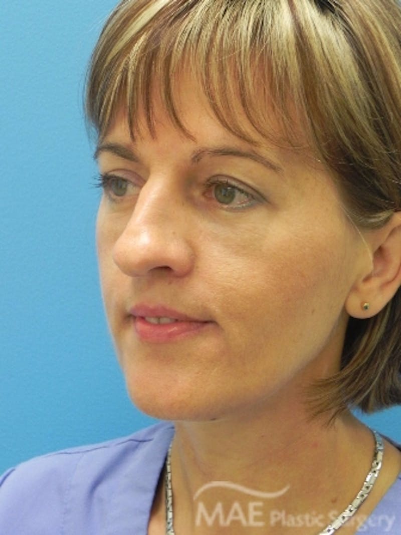 Rhinoplasty Before & After Gallery - Patient 202579 - Image 3