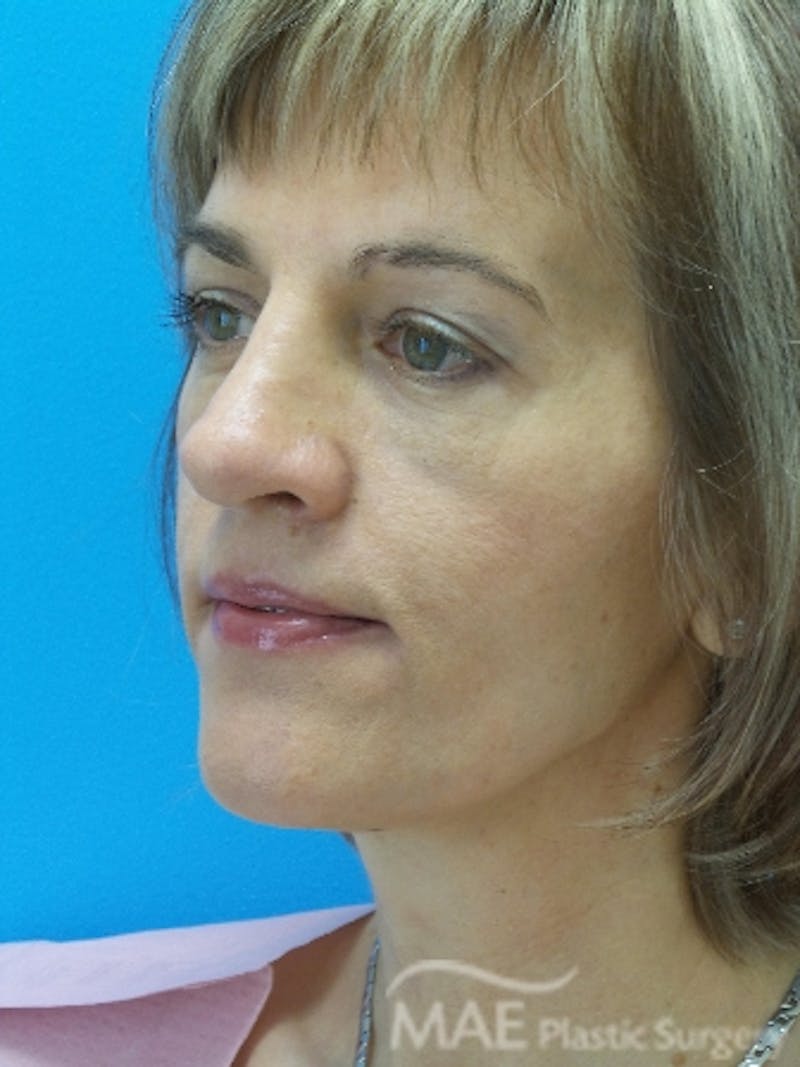 Rhinoplasty Before & After Gallery - Patient 202579 - Image 4
