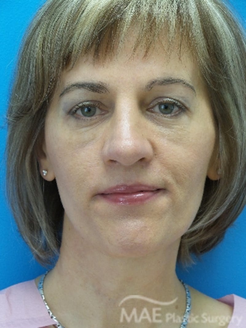 Rhinoplasty Before & After Gallery - Patient 202579 - Image 6