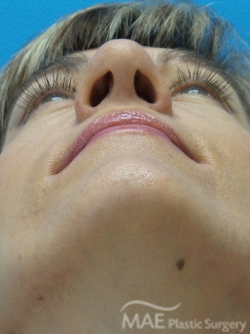 Rhinoplasty Before & After Gallery - Patient 202579 - Image 8