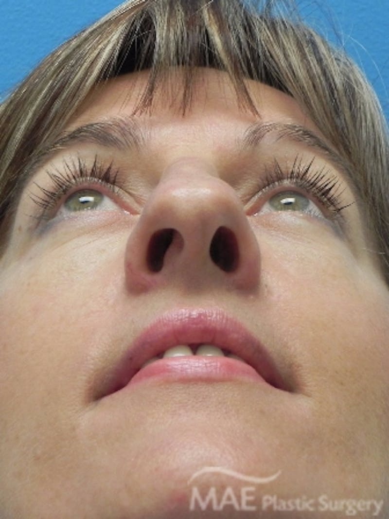 Rhinoplasty Before & After Gallery - Patient 202579 - Image 7