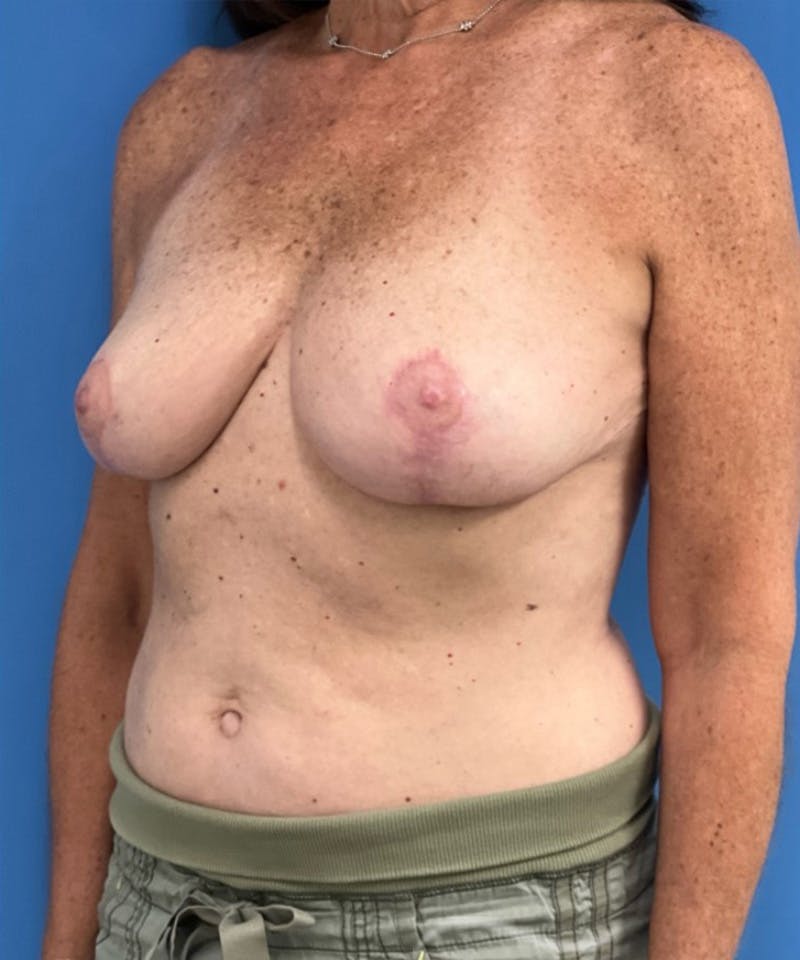 Breast Reduction Before & After Gallery - Patient 102916 - Image 4