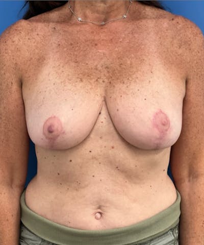 Breast Reduction Before & After Gallery - Patient 102916 - Image 2