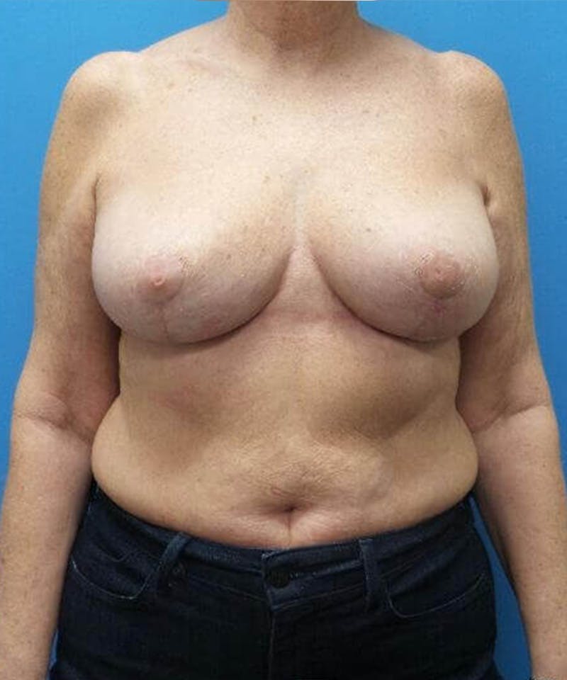 Breast Reduction Before & After Gallery - Patient 192428 - Image 2