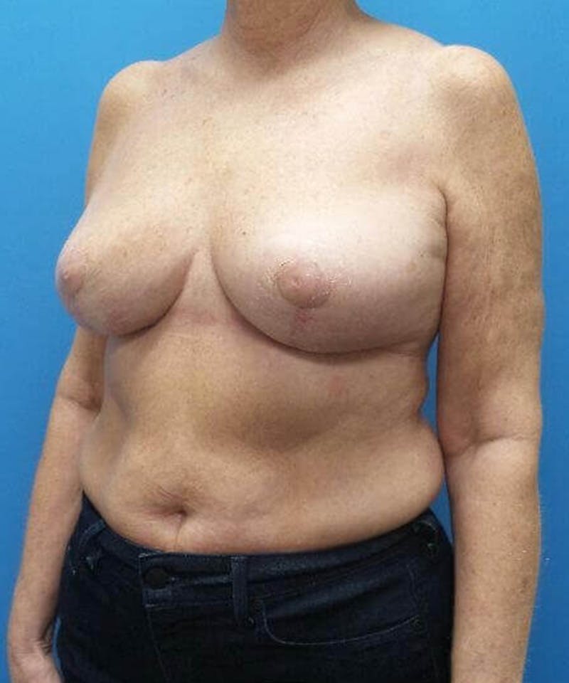 Breast Reduction Before & After Gallery - Patient 192428 - Image 4