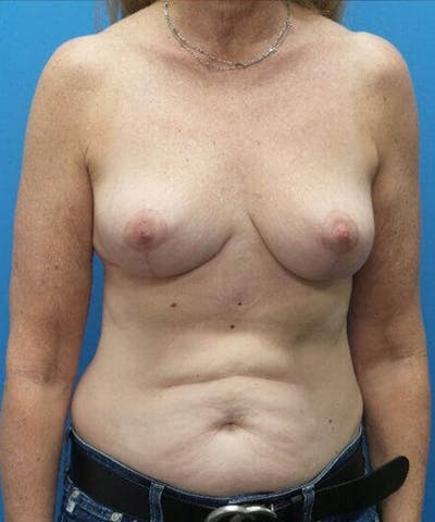 Breast Reduction Before & After Gallery - Patient 231888 - Image 2