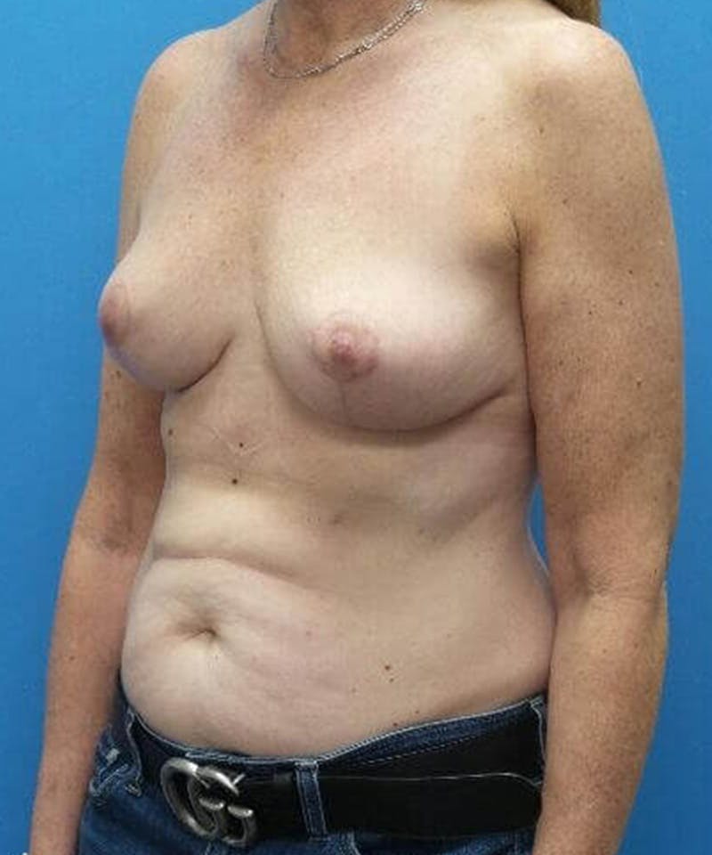 Breast Reduction Before & After Gallery - Patient 231888 - Image 4