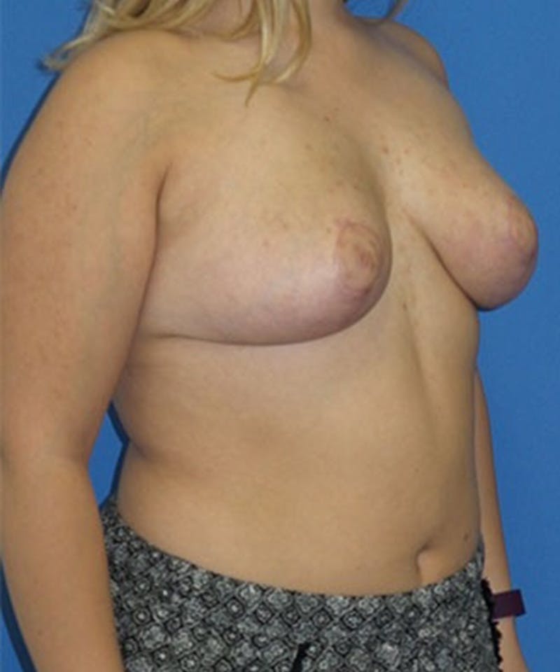 Breast Reduction Before & After Gallery - Patient 229236 - Image 4