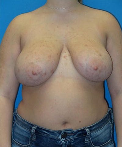 Breast Reduction Before & After Gallery - Patient 229236 - Image 1