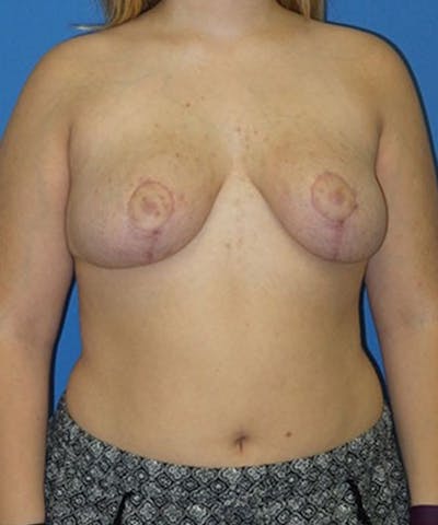 Breast Reduction Before & After Gallery - Patient 229236 - Image 2