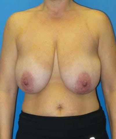 Breast Reduction Before & After Gallery - Patient 985944 - Image 1