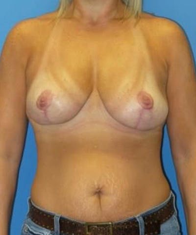 Breast Reduction Before & After Gallery - Patient 985944 - Image 2