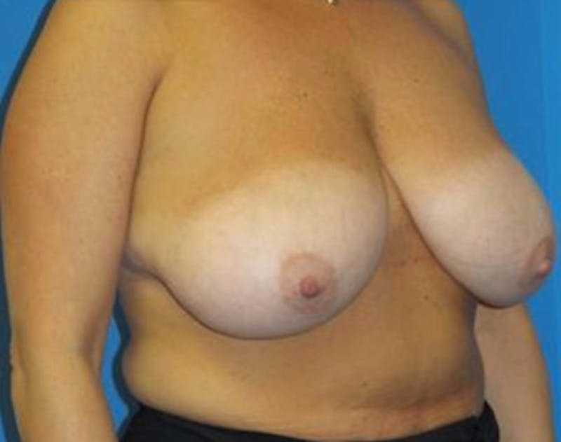 Breast Reduction Before & After Gallery - Patient 115969 - Image 3