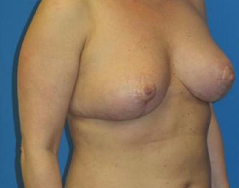 Breast Reduction Before & After Gallery - Patient 115969 - Image 4