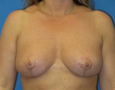 Breast Reduction Before & After Gallery - Patient 115969 - Image 2