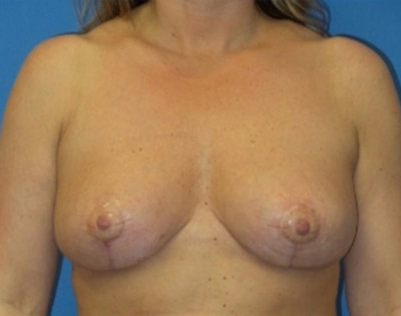 Breast Reduction Before & After Gallery - Patient 115969 - Image 2