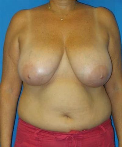 Breast Reduction Before & After Gallery - Patient 480695 - Image 1