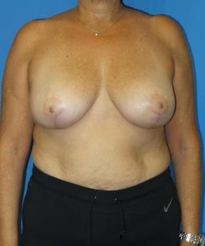Breast Reduction Before & After Gallery - Patient 480695 - Image 2