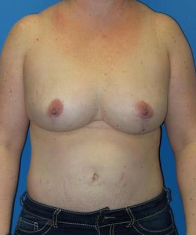 Breast Reduction Before & After Gallery - Patient 401740 - Image 2
