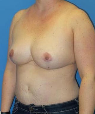 Breast Reduction Before & After Gallery - Patient 401740 - Image 4