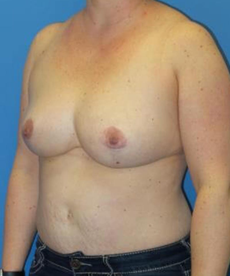 Breast Reduction Before & After Gallery - Patient 401740 - Image 4