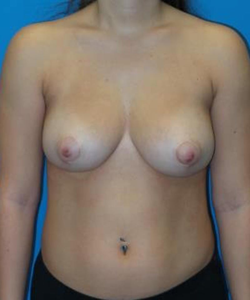 Breast Reduction Before & After Gallery - Patient 327101 - Image 2