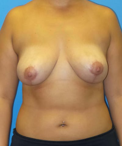 Breast Reduction Before & After Gallery - Patient 100344 - Image 2
