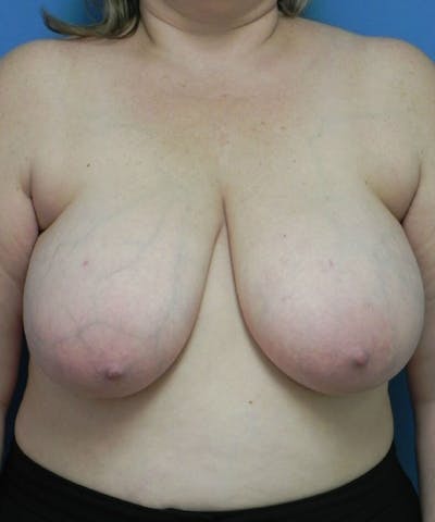 Breast Reduction Before & After Gallery - Patient 223107 - Image 1