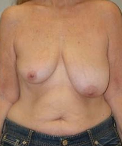 Breast Reduction Before & After Gallery - Patient 246407 - Image 1