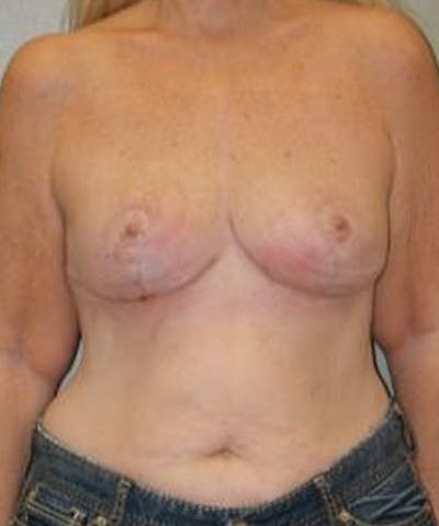Breast Reduction Before & After Gallery - Patient 246407 - Image 2