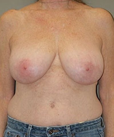 Breast Reduction Before & After Gallery - Patient 107118 - Image 1