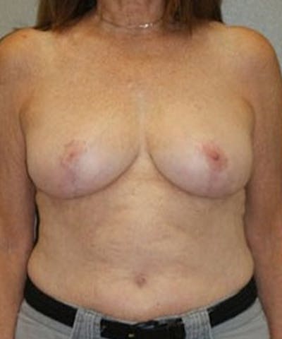 Breast Reduction Before & After Gallery - Patient 107118 - Image 2