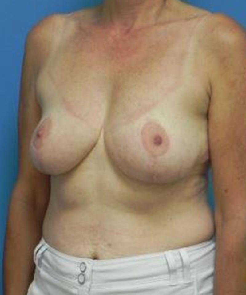Breast Reduction Before & After Gallery - Patient 154127 - Image 4