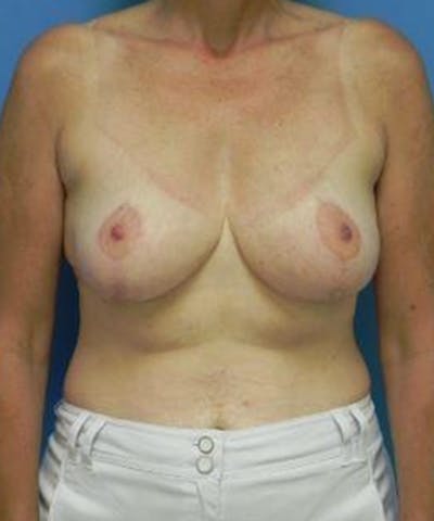 Breast Reduction Before & After Gallery - Patient 154127 - Image 2