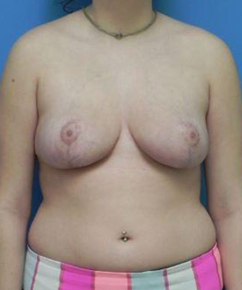 Breast Reduction Before & After Gallery - Patient 408408 - Image 2