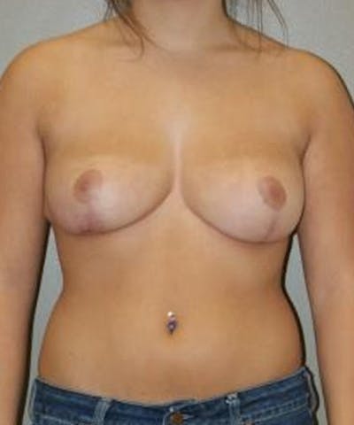 Breast Reduction Before & After Gallery - Patient 962170 - Image 2