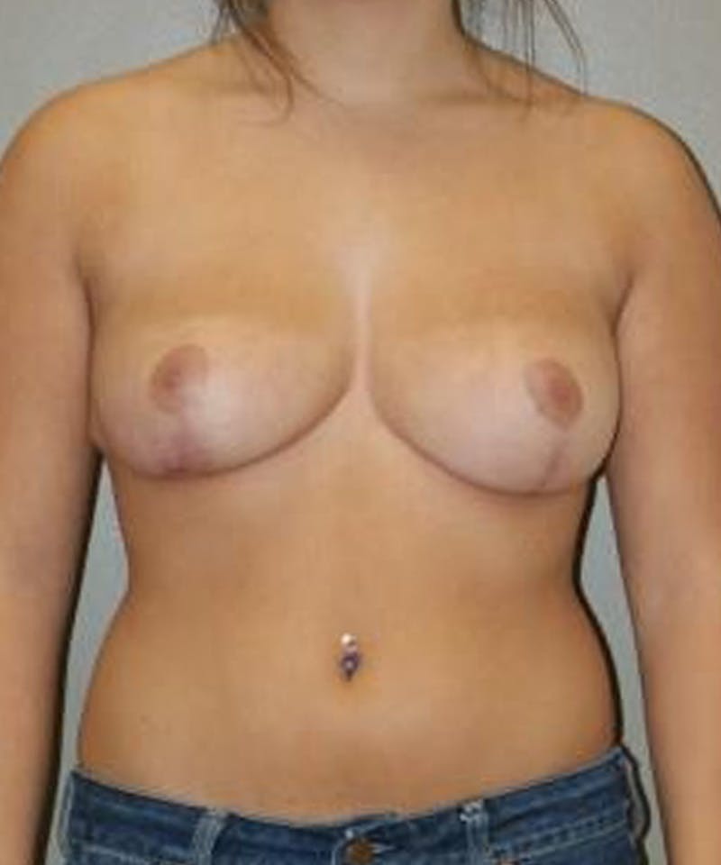 Breast Reduction Before & After Gallery - Patient 962170 - Image 2